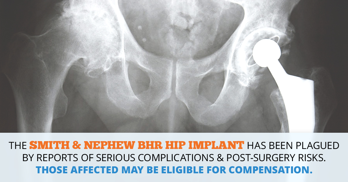 Smith & Nephew BHR Hip Implant Lawsuits // Consumer Safety Watch