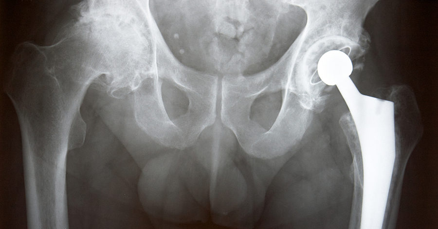 Hip Replacement Defect Compensation