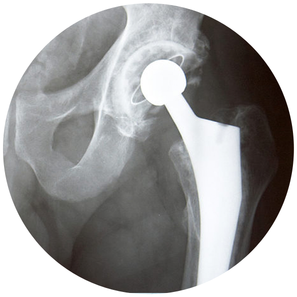 Hip Replacement Implant Lawsuit // Consumer Safety Watch