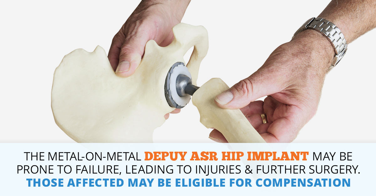 Depuy ASR Hip Implant Lawsuit | Consumer Safety Watch