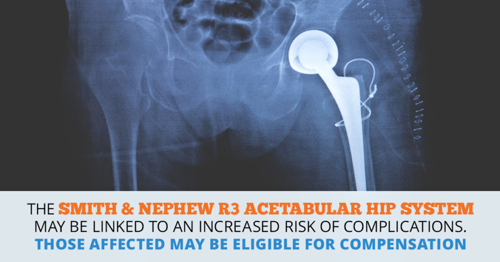 Smith & Nephew R3 Acetabular Hip System Lawsuit | Consumer Safety Watch ...