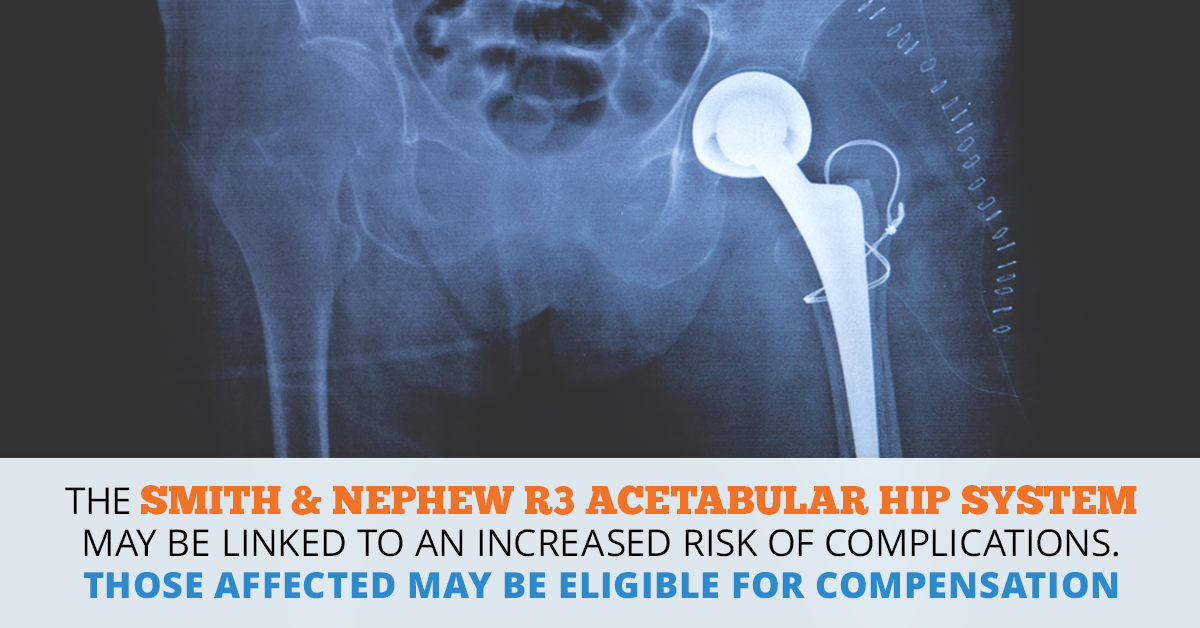 Smith & Nephew R3 Acetabular Hip System Lawsuit | Consumer Safety Watch