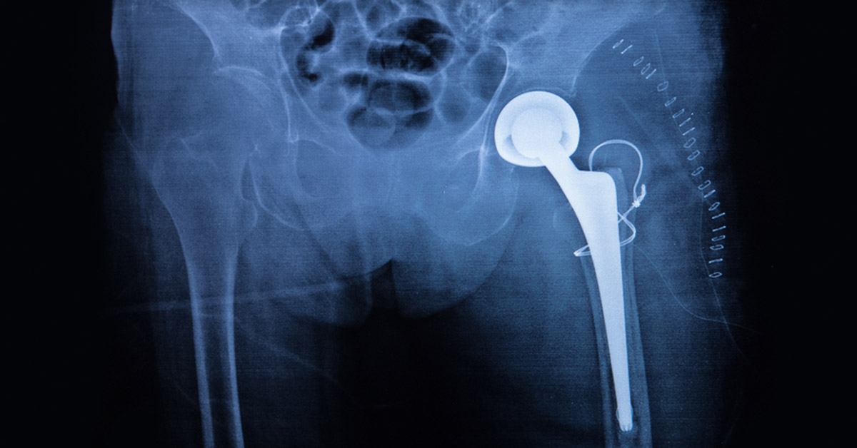 Can your hip implant kill you?
