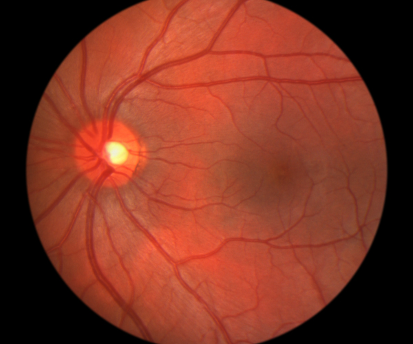 Elmiron Retina Damage