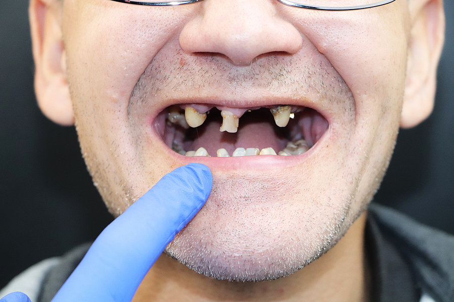 Suboxone, Belbuca, Zubsolv Tooth Decay and Tooth Loss