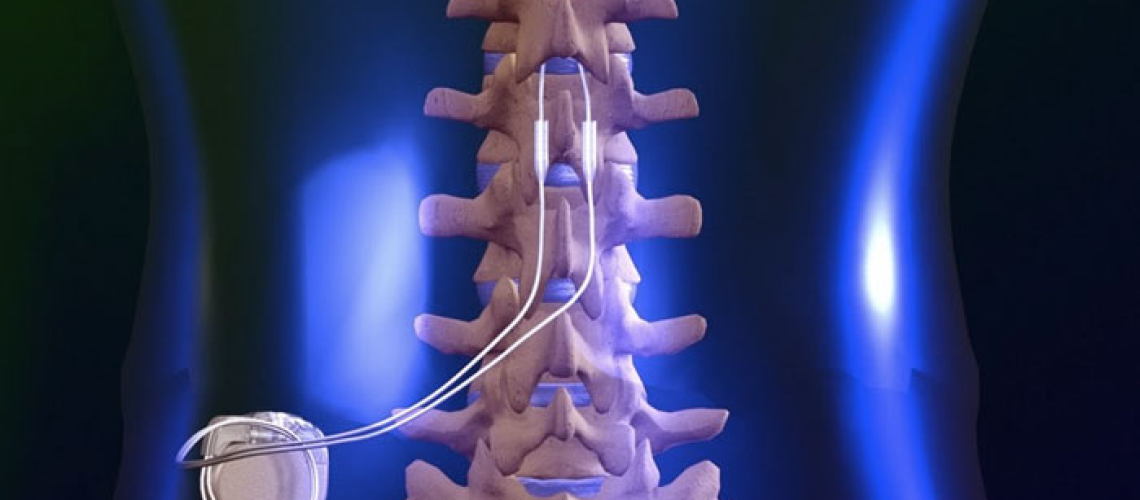 Spinal Cord Stimulator Lawsuit